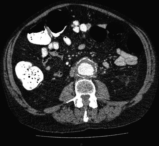 Abdominal aortic aneurysm with some wall standing thrombus but without any signs of rupture.