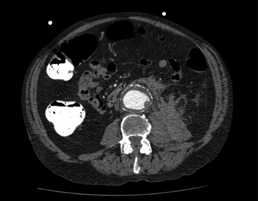 Repeat CT scan of the abdomen, showing evidence of a contained rupture.