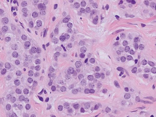 Carcinoid tumor at the cystic duct margin (H&E, magnification ×40).