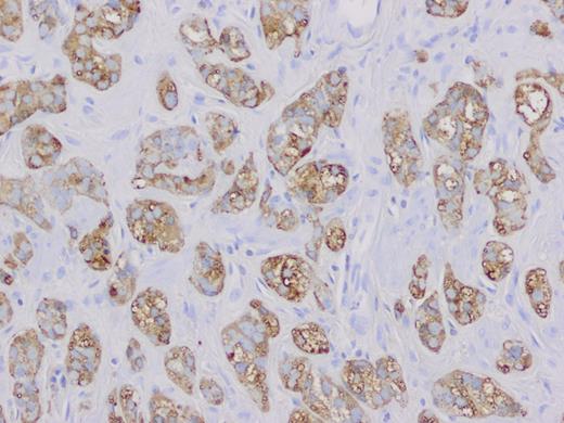 Chromogranin positive neoplastic cells (magnification ×20).