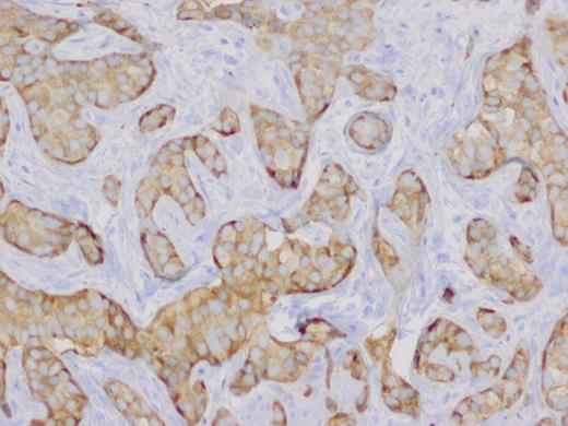 Synaptophysin positive neoplastic cells (magnification ×20).