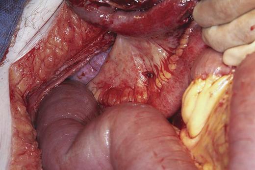 Laparotomy findings of transition point of small bowel obstruction at neck of perineal hernia.