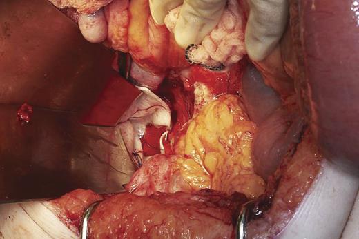 Bridging of perineal defect with Strattice™ Tissue Matrix before covering with omentum.