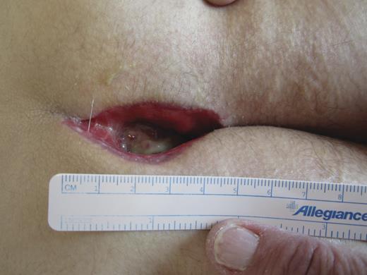 4 Weeks post-op.