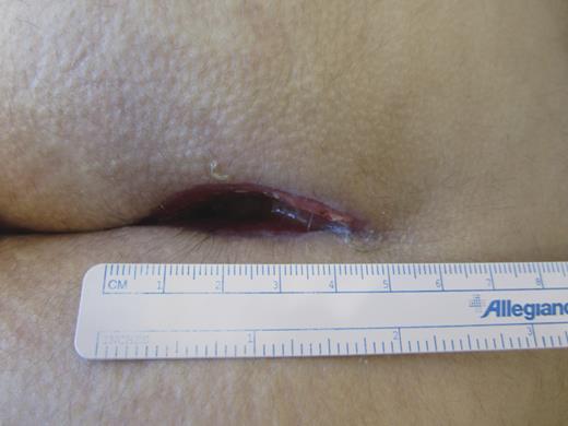 5 Weeks post-op.