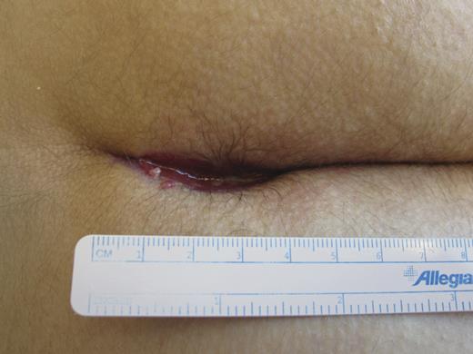 7 Weeks post-op.