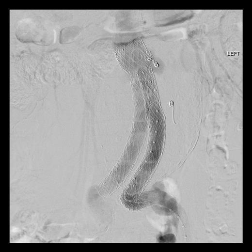 Digital subtraction angiography showing significant type 3a endoleak with component separationon the left iliac limb (black arrow). Both common iliac arteries were long and tortuous.