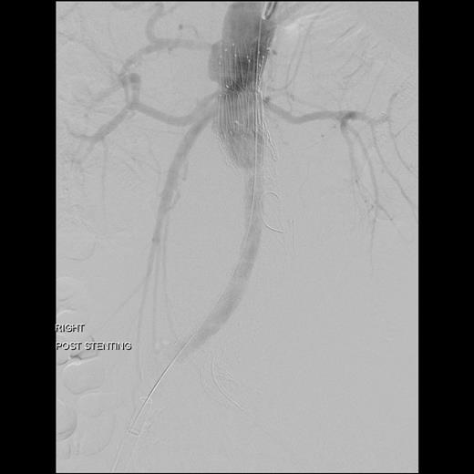 The completion angiography showed adequate sealing with no endoleak.
