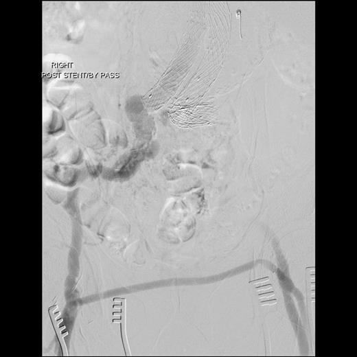 Angiography showing a femorofemoral crossover bypass.