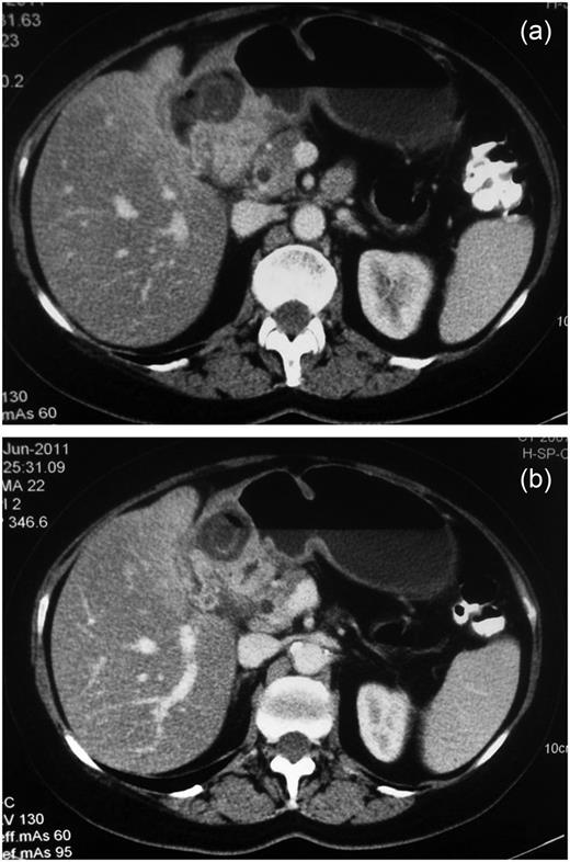 (a and b) CT of the abdomen.