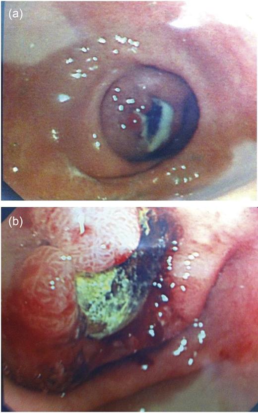 (a and b) Endoscopic visualization of fistula and gallstone.