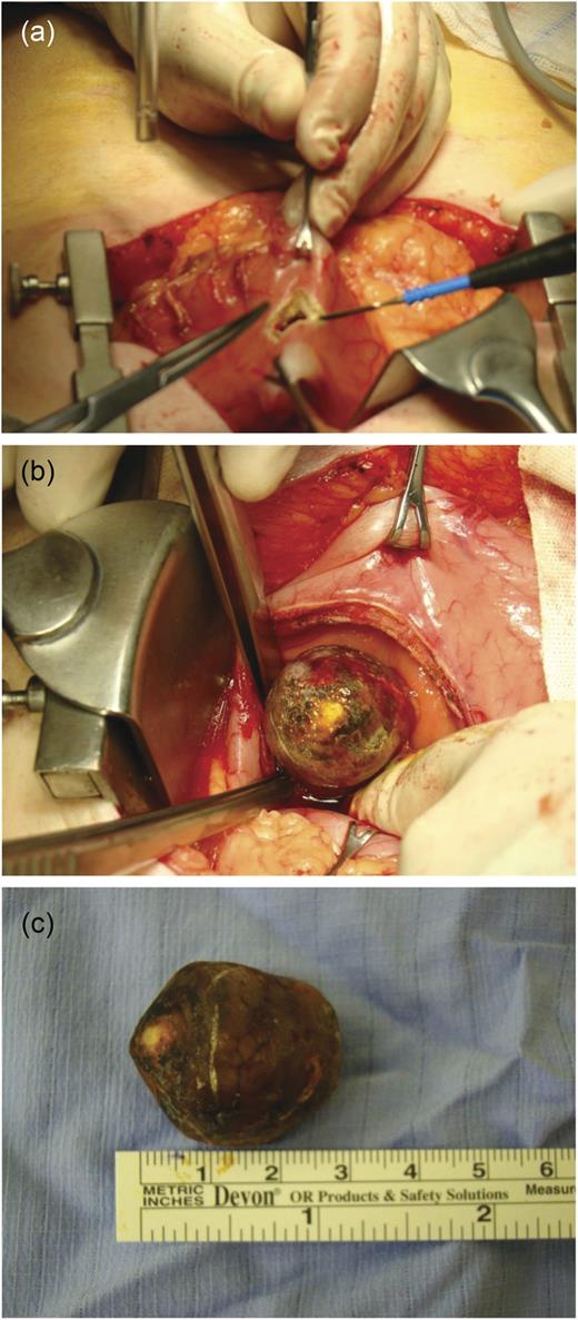 (a–c) Intraoperative visualization of fistula and gall stone, specimen removed.