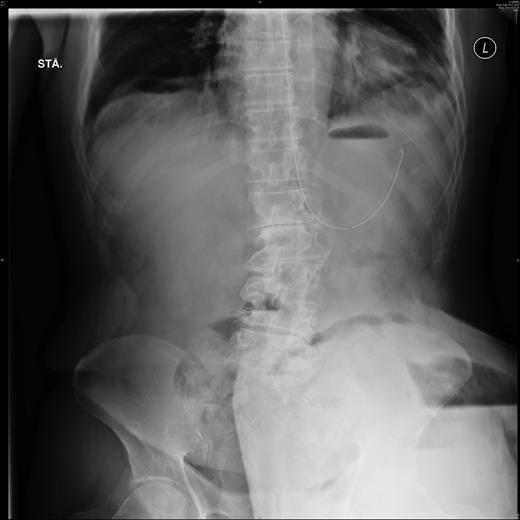 Plain film abdominal X-ray showing the trapped stomach in the large parastomal hernia on the patient's lower left side. Notice the fundus-like air on the outer left-hand side of the trapped part. Also visible is free air inside the parastomal hernia.