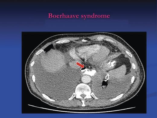 CT scan demonstrating left intercostal drain in situ. There is a tear in the distal third of the oesophagus on the left posterolateral aspect. Contrast has extravasated to fill a cavity in the posterior mediastinum ∼3.9 × 2.5 cm at its widest point in the axial plane and ∼10.5 cm in craniocaudal extent.