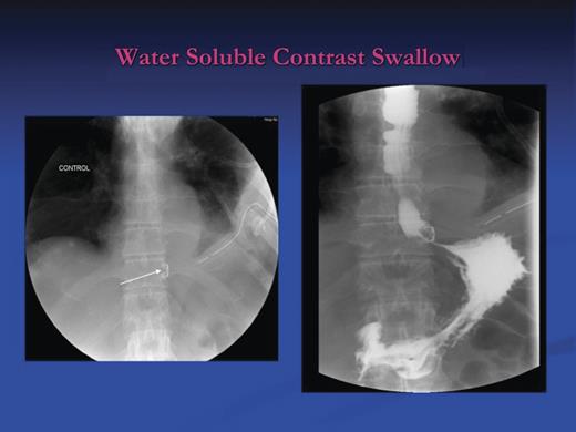 Contrast swallow after the application of the OTSC. Contrast passed beyond the distal oesophageal staples into the stomach and the duodenum; no contrast leakage is demonstrated.