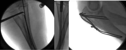 Left—K-wire secured and removed with a pair of artery clips. Right—Final shots of the Tension band wiring construct.