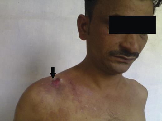 Arrow heads show ulcer at the time of presentation.