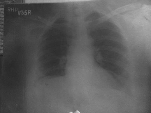 Pre-op X-ray chest PA view.