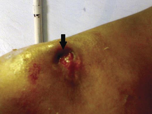 Arrow heads show ulcer after taking ATT with granulation tissue.