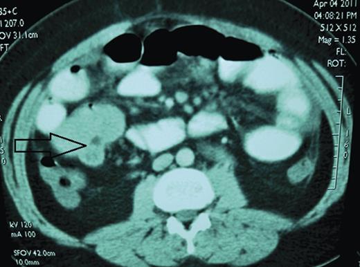 The 26-year-old man. Axial contrast-enhanced CT scan shows 5 × 5 cm small bowel mass (arrow). Operative findings confirmed ileoileal intussusception.