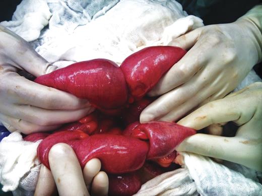 Intraoperative image of a double ileoileal intussusception. First one located ∼20 cm from the ligament of Treitz and the second about 120 cm distal to the first intussusception.