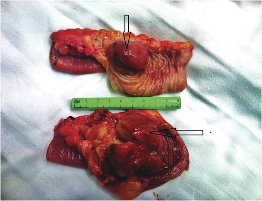 The surgical specimen comprised two segments of resected small bowel. Note the intraluminal mass (lead point) that caused the intussusception (arrows).