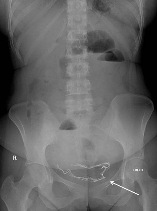 A radio-opaque mark visible at the pelvis (an arrow).