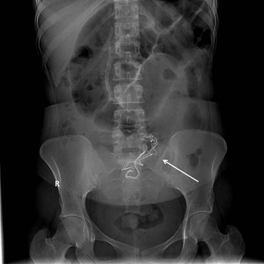 Proximal small intestinal dilatation with the radio-opaque mark migrated proximally to the abdomen (arrow), indicating its mobile nature.