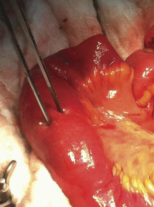 Intraluminal foreign body visible at the ileum with an intact normal wall (forceps).
