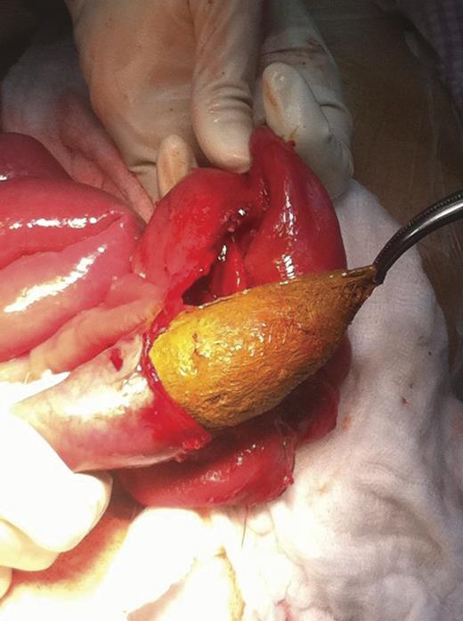 Intraoperative removal of the foreign body from the jejunum (arrow).