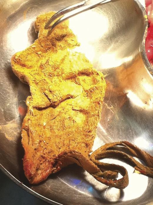 Foreign body found to be a retained surgical gauze.