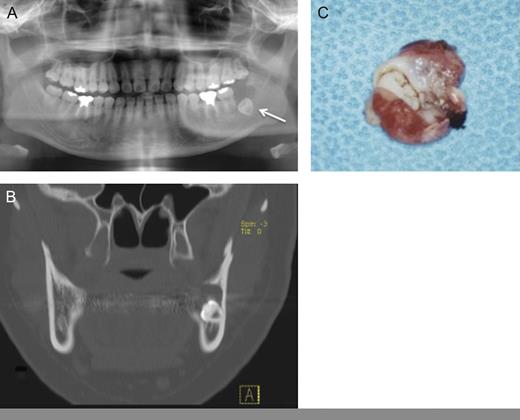 (A) Panoramic radiography: a cystic lesion with wisdom tooth was seen in the left mandibular region. (B) CT showed a cystic lesion with bone destruction. (C) Gross appearance of surgical specimen showed like dentigerous cyst.