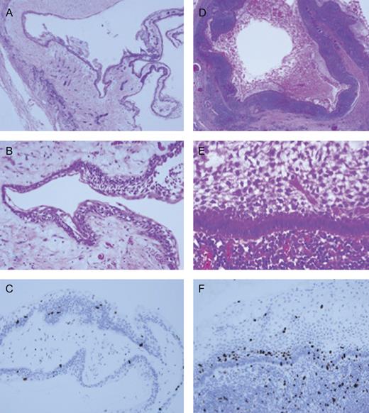 Histopathological findings. (A; ×40) and (B; ×200) showed pathological findings of primary unicystic ameloblastoma and (D; ×20) and (E; ×300) showed of metastatic lymph node. (C; ×200) and (F; ×300). Immunochemical staining of Ki-67 (MIB-1) revealed that the metastatic lesion was relatively high indexes compared with primary lesion.