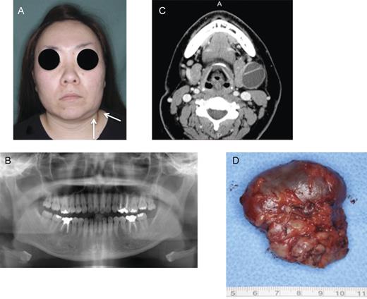 (A) Painless swelling of the left submandibular region occurred. (B) Panoramic radiography post-operation: no recurrence of ameloblastoma. (C) Computed tomography (C) showing a bilobed mass arising from the submandibular gland. (D) Macroscopic findings of extirpated submandibular gland including mass. The extirpated specimen had a smooth surface and a thin capsule. The contents of mass were yellowish, transparent, mucinous liquid.