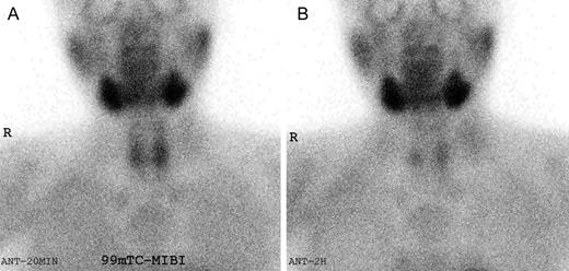 99mTc-sestamibi (MIBI) scintigraphy. (A) MIBI uptake in both thyroid areas 20 min after MIBI injection. (B) MIBI uptake in both inferior parathyroids 2 hours after MIBI injection.