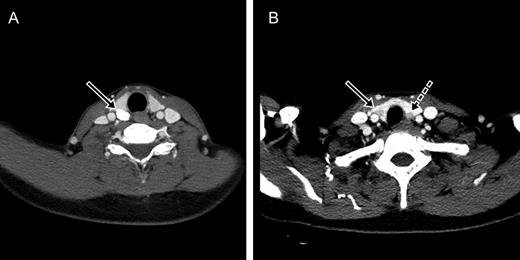 Parathyroid glands and the thyroid nodule on computed tomography. (A) A calcified nodule posterior to the right superior thyroid (arrow). (B) A solid nodule in the right lower thyroid gland (arrow) and an enlarged parathyroid gland posterior to the left inferior thyroid (dotted arrow).