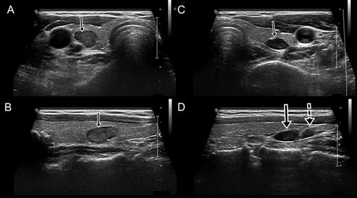 Sonography showed the right parathyroid gland within the thyroid and the adjoining left parathyroid glands. (A) Transverse view of the right parathyroid gland within the thyroid (arrow). (B) Longitudinal view of the right parathyroid gland (arrow). (C) Transverse view of the left superior parathyroid gland. (D) Longitudinal view of the left superior (arrow) and inferior (dotted arrow) parathyroid glands. The left superior parathyroid had migrated to an inferior position.