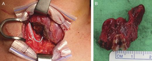 The resected thyroid. (A) Dotted lines show the right lower thyroid contour before resection. (B) Split intrathyroidal parathyroid gland.