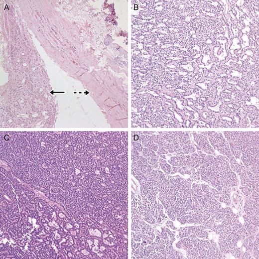 Microscopic finding from the parathyroid glands. (A) Right superior parathyroid hyperplasia (arrow) with a calcified nodule (dotted arrow) (H&E stain Ă—100). (B) Left superior parathyroid hyperplasia (H&E stain, Ă—200). (C) Right inferior parathyroid hyperplasia (H&E stain, Ă—200) was within the thyroid. (D) Left inferior parathyroid hyperplasia (H&E stain, Ă—200).