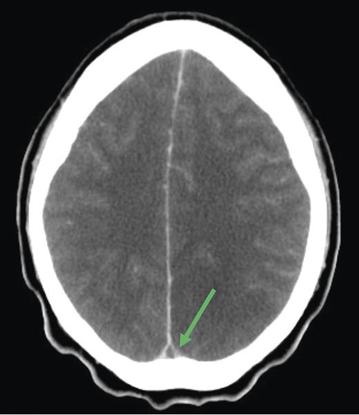 Head CT with contrast: note empty delta sign.