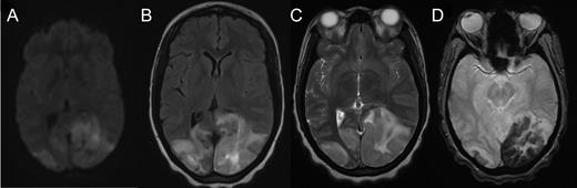 Axial MRI demonstrating cerebral tissue injuries from venous hypertension with the associated ischemia: (A) Diffusion-weighted imaging (DWI) MRI. (B) Fluid-attenuated inversion recovery (FLAIR) imaging. (C) T2-weighted MRI. (D) Gradient-echo (GRE) imaging.