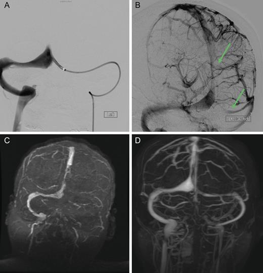 Dural sinus venogram (A) Prior to endovascular mechanical thrombectomy (B) Post mechanical thrombectomy. (C) Pre-intervention MRV demonstrating complete occlusion of the left transverse sinus and near occlusion of the posterior portion of the superior sagittal sinus. (D) Post-intervention MRV demonstrating persistent recanalization of the left transverse and sigmoid sinuses, along with much improved flow in the posterior superior sagittal sinus. Note the recanalization of the left transverse sinus and the much improved flow in the superior sagittal sinus.