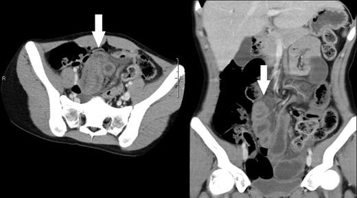 Computed tomographic scans of axial and coronal views of abdomen demonstrating edematous small intestines (arrows).