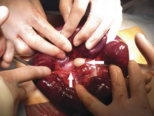 Intraoperative finding showing necrotic small intestines and a mesenteric defect (arrows) in the jejunal region.