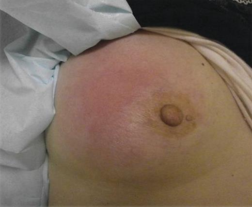 The right breast was swollen and erythematous.
