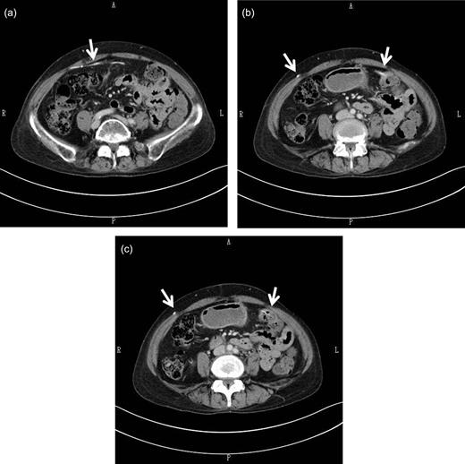 Abdominal CT scan findings. The shunt catheter (white arrow) extended through the right-rectus sheath (a), crossed the midline to the left side of the abdomen (a, b) and was inside the splenic flexure of the colon (b, c). There was no free air or other abnormalities in the abdominal cavity.