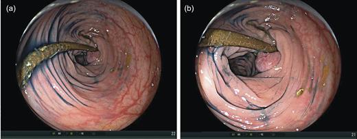 Colonoscopy showed the distal catheter within the transverse colon, ∼40 cm proximal to the anal verge (a). An inflammatory polyp was present at the penetration site in the colon wall (b).