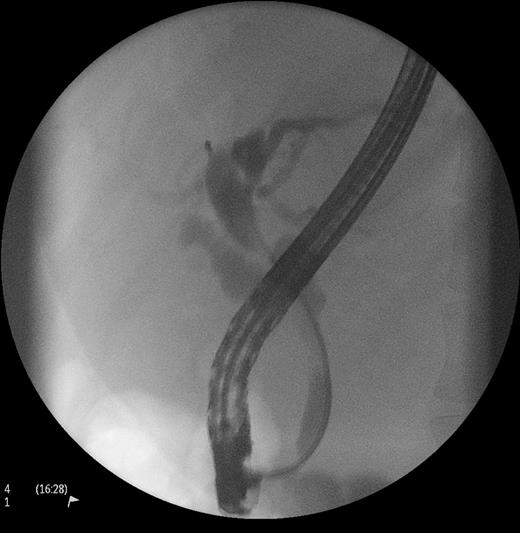 ERCP showing CBD stricture.
