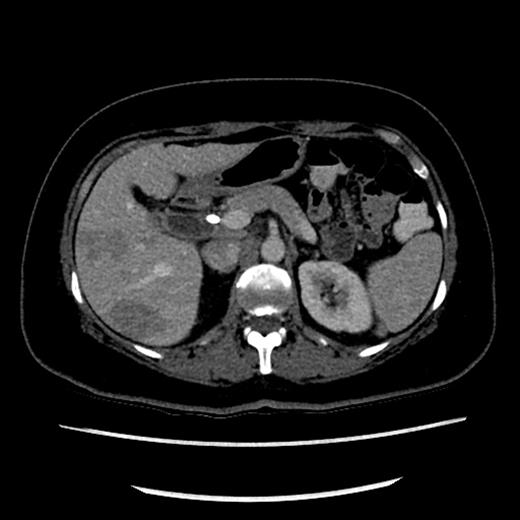 CT scan showing hypodense lesions in the liver with CBD stent in situ.