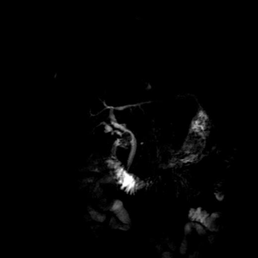 MRCP confirming CBD stricture.